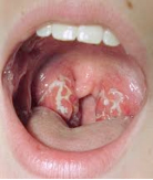 In swelling will throat benadryl reduce Why Benadryl