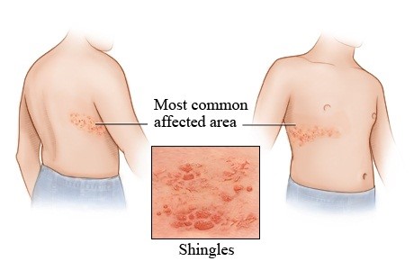 can dogs get chicken pox or shingles from humans